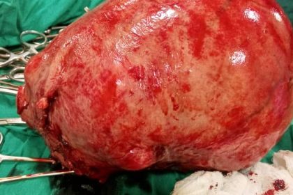 Ugandan Doctors Remove 3.0Kg+ Weighed Fibroid From Woman 