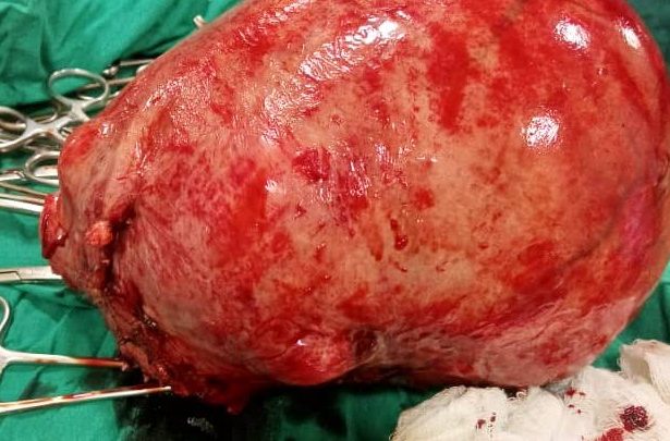 Ugandan Doctors Remove 3.0Kg+ Weighed Fibroid From Woman 