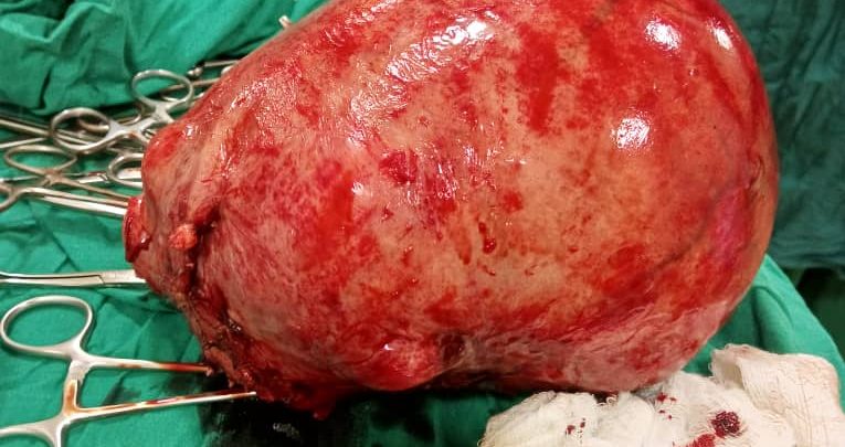 Ugandan Doctors Remove 3.0Kg+ Weighed Fibroid From Woman 