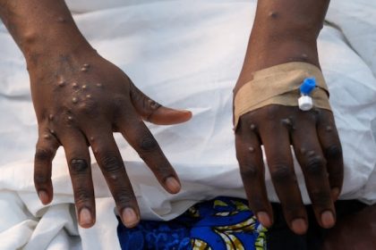 Ghana Reports First Mpox Case This Year