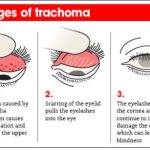 Egypt Becomes Seventh Country In WHO Eastern Mediterranean Region To Eliminate Trachoma After 3,000 Year Burden