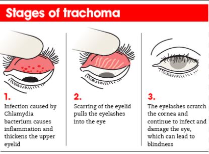 Egypt Becomes Seventh Country In WHO Eastern Mediterranean Region To Eliminate Trachoma After 3,000 Year Burden